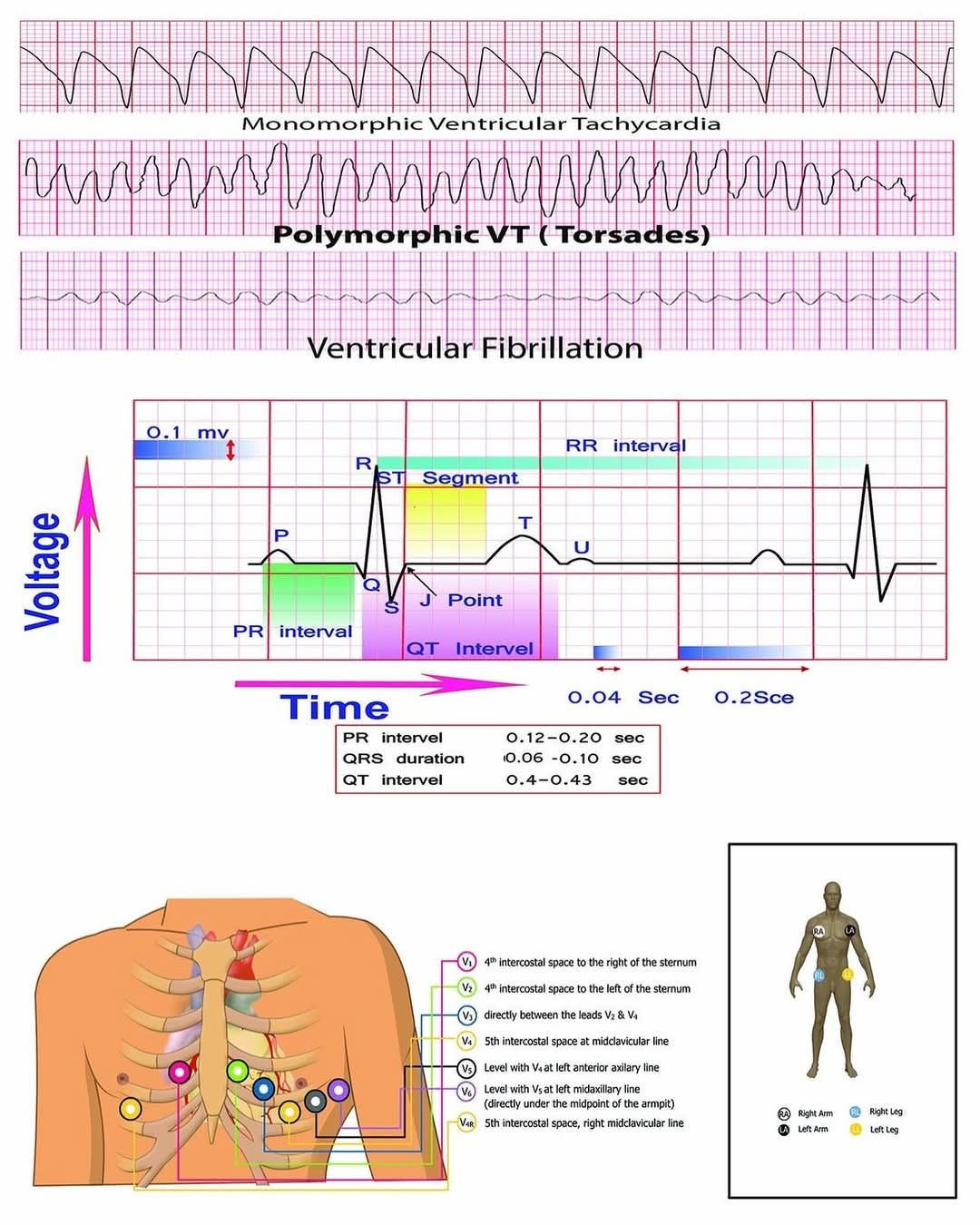 Global - ECG Review 🫀💯 #ecg #ekg #cardiology #ecginterpretation # ...