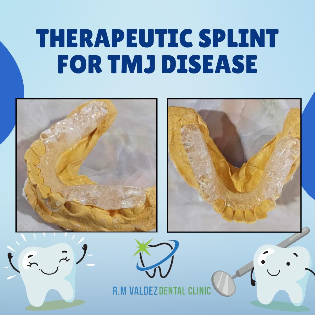 R.M - Therapeutic splint for TMJ DISEASE If you’re experiencing lock ...