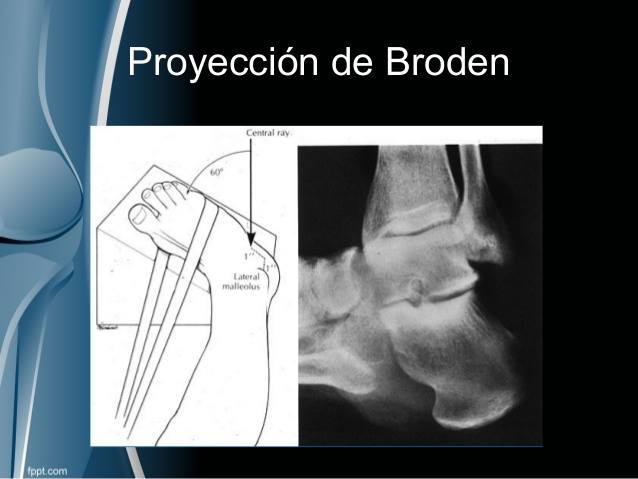 Mi radiología - Metodo de Broden I. Esta proyección se usa... | Facebook