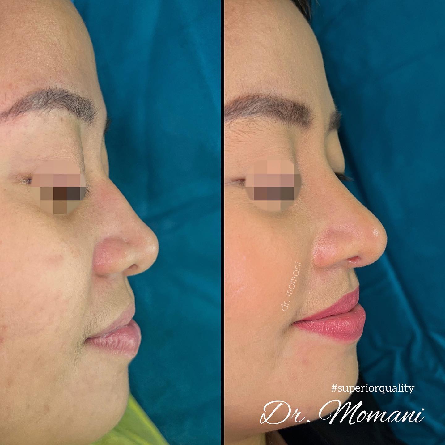 Light, - ⚠️Pure Cartilage Rhinoplasty (Autologous Rhinoplasty) From a ...