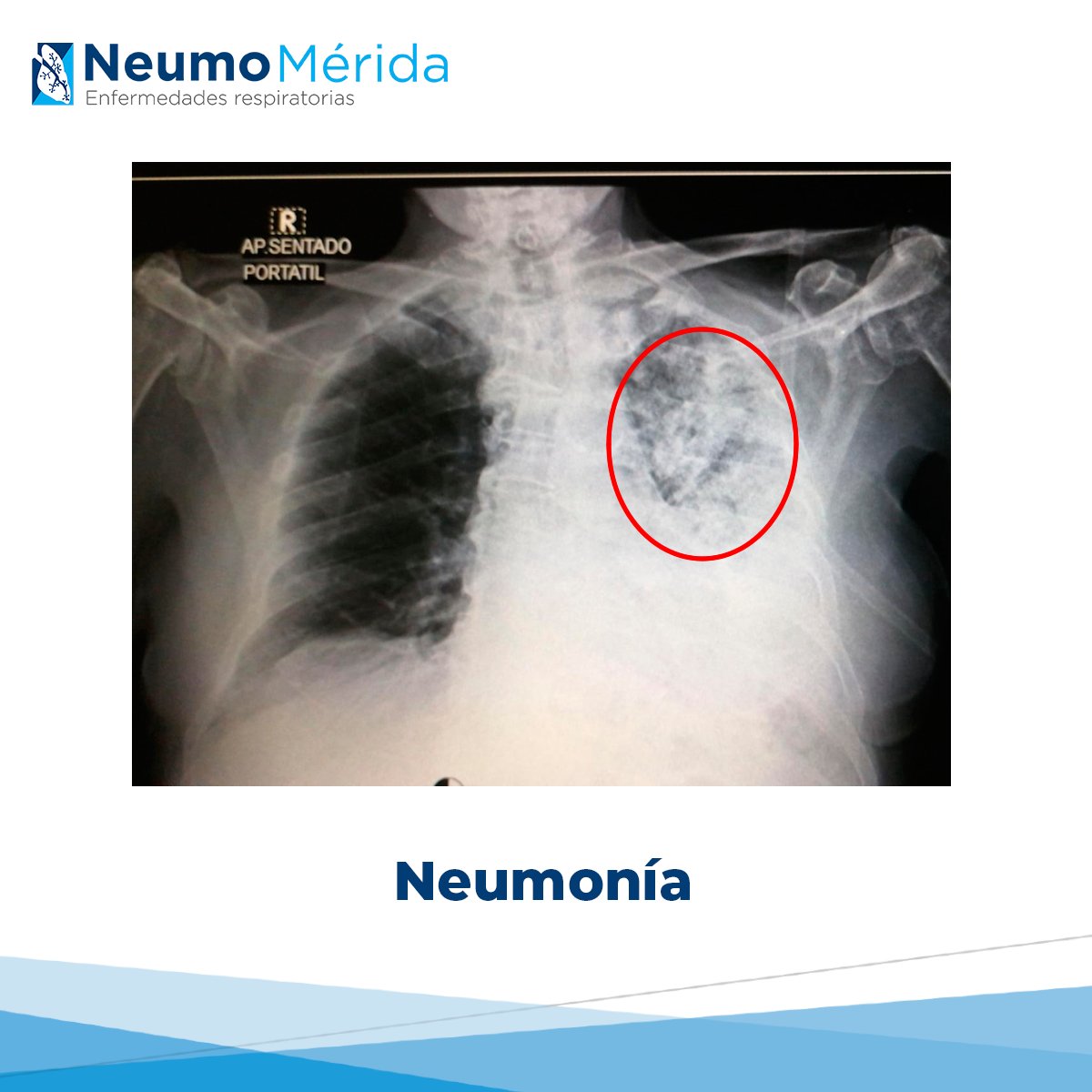 NeumoMérida - 🟡¿QUÉ ES LA NEUMONÍA? En nuestro medio...