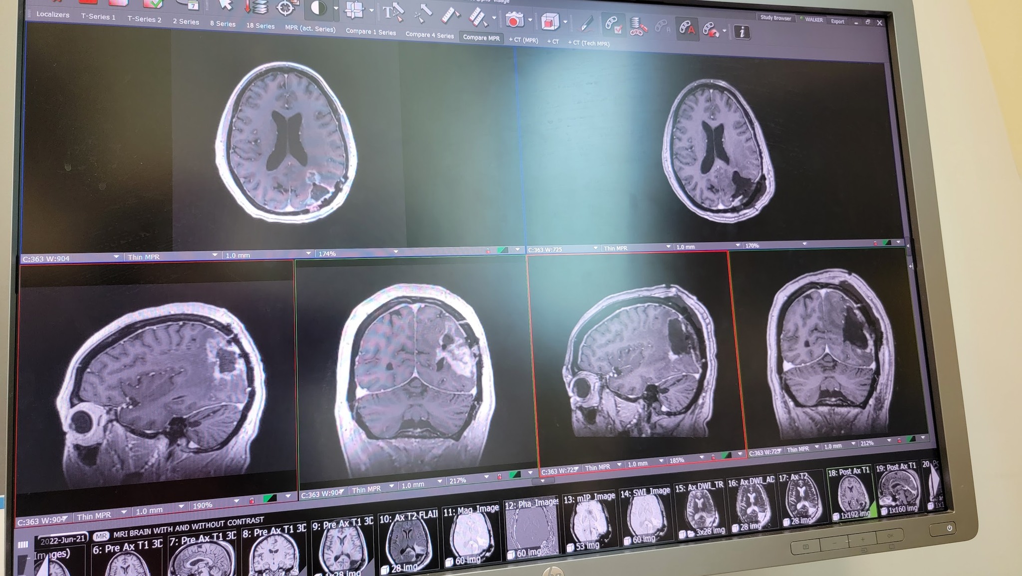 Impact of cuts to brain cancer research funding