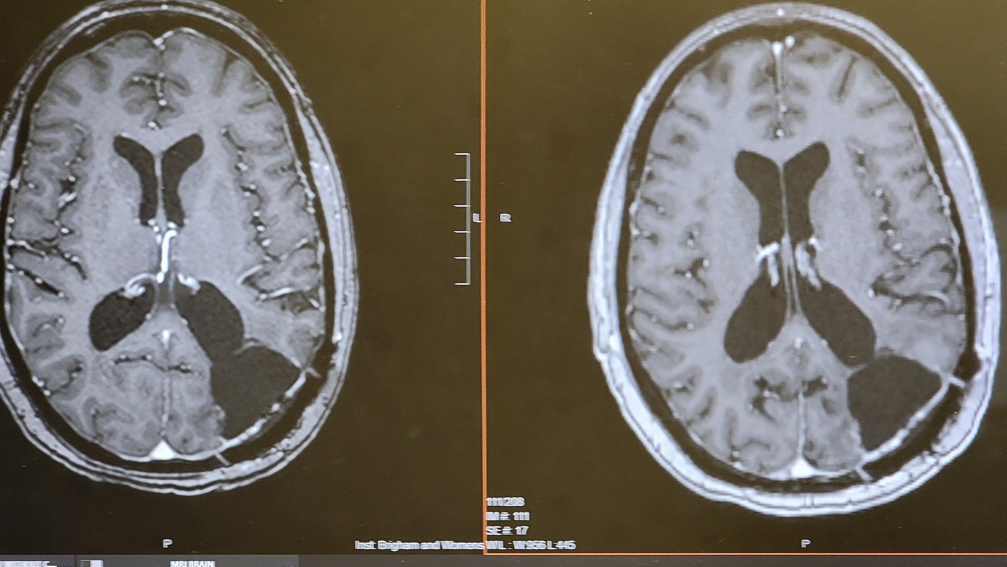 Impact of cuts to brain cancer research funding
