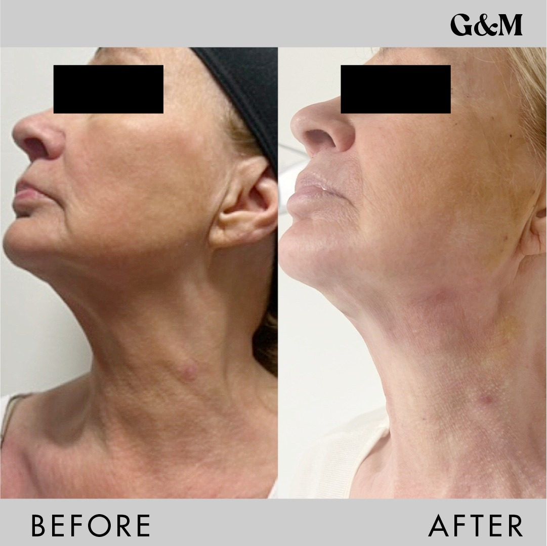 G&M Healthcare - What can a thread lift do for the neck?... | Facebook