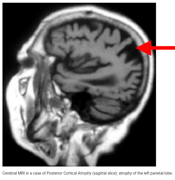 Cerebral MRI in a case of #PosteriorCorticalAtrophy (sagittal slice): # ...