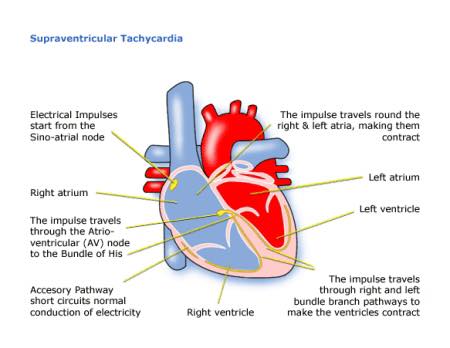 急症室日務 - #心電圖（17） Sinus ventricular tachycardia SVT | Facebook