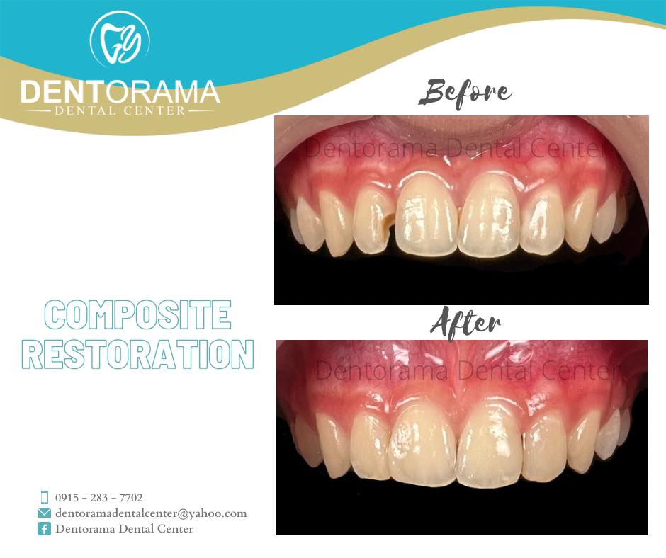 Dentorama - Restoration of carious lateral incisor using composite. # ...