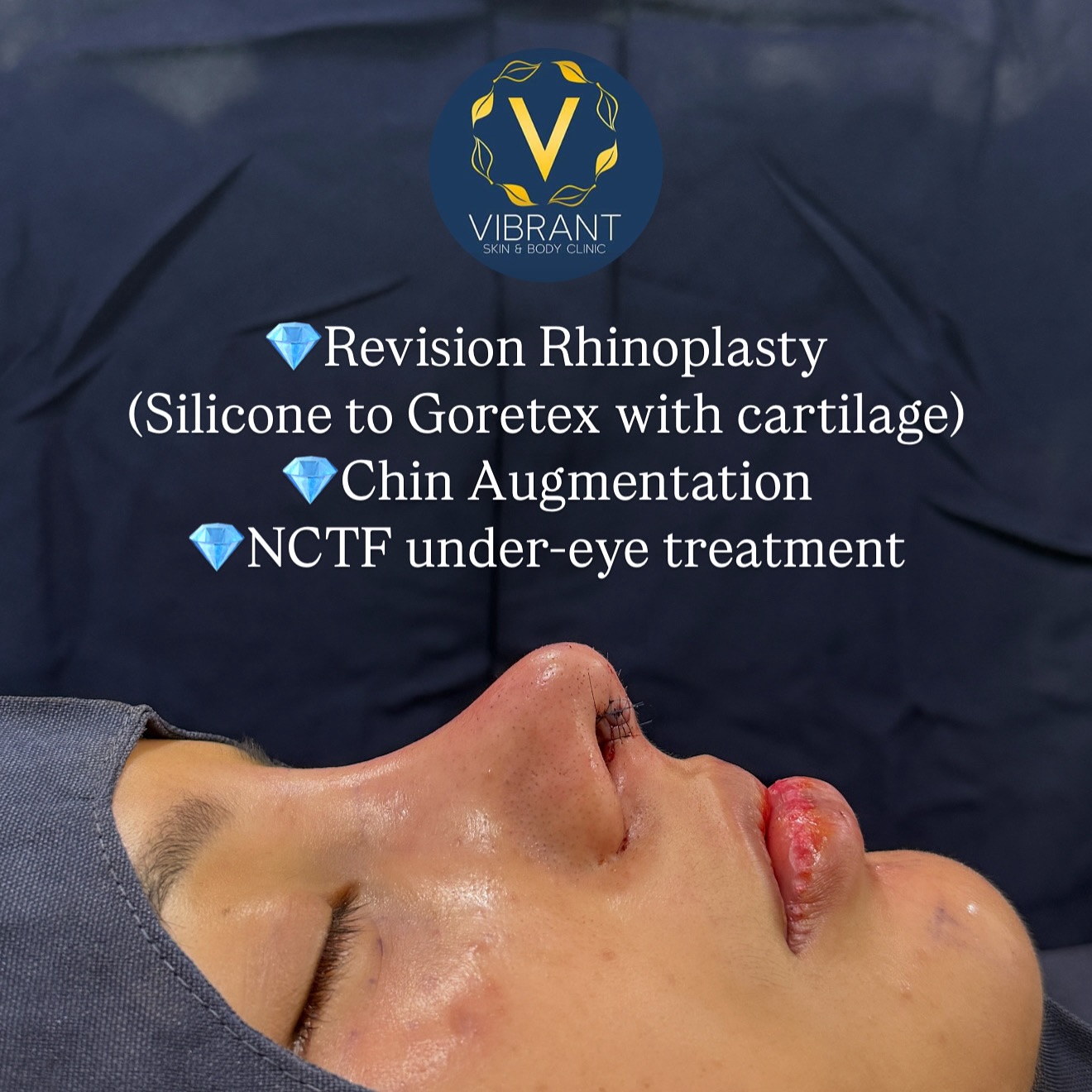 Vibrant - MY 💎 REVISION RHINOPLASTY TO RESTORE FACIAL HARMONY AND ...