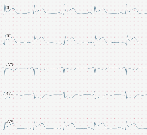 Ecgbuddy - Your patient has severe chest pain. What's the... | Facebook