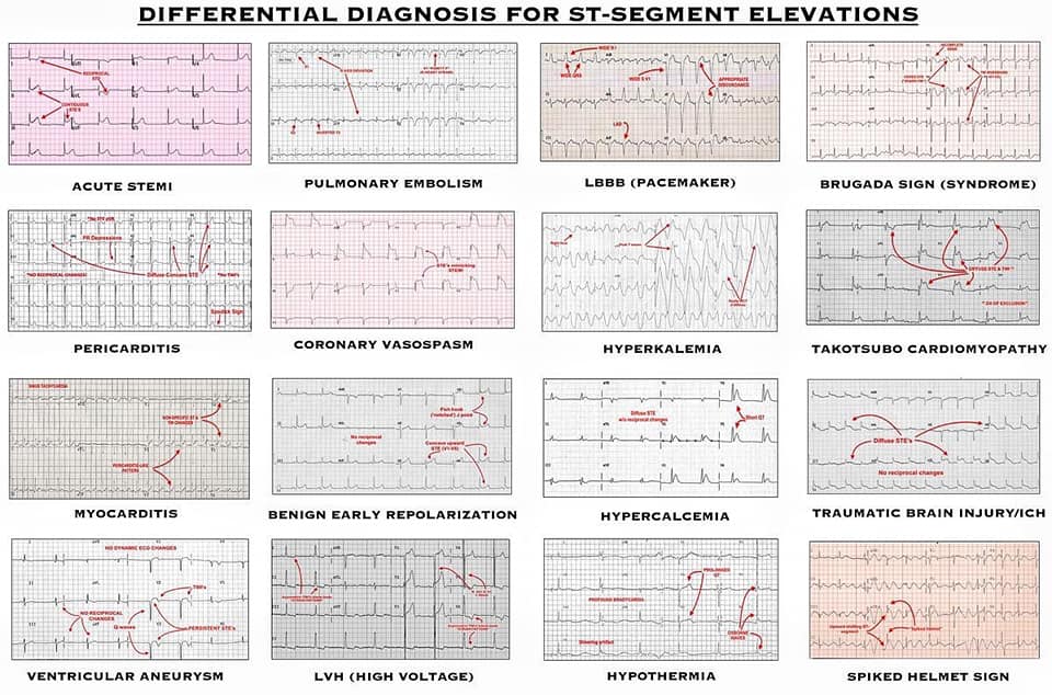 DD of st segment elevation - Cardiology and CCU