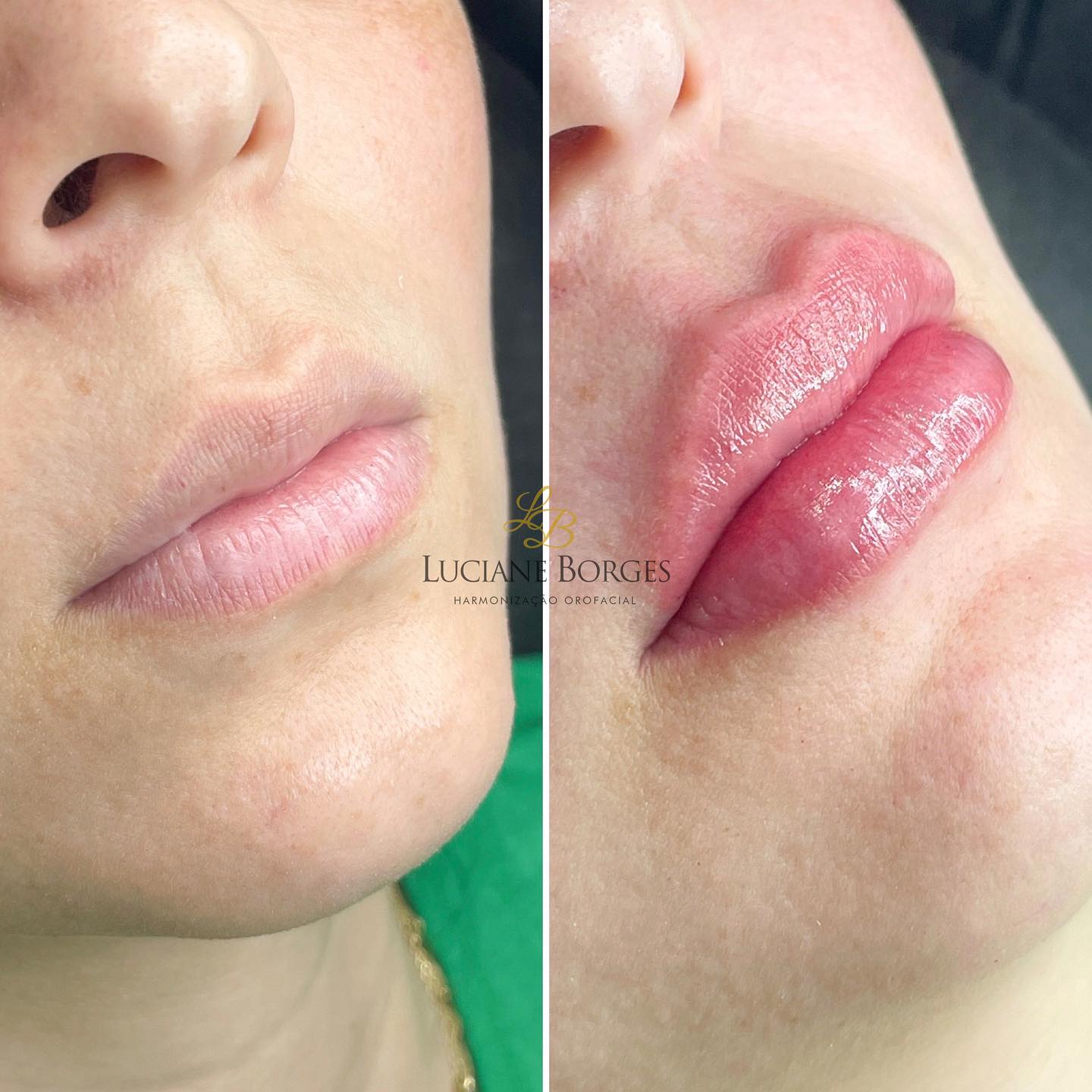 Dra. - Vamos dar um up nos seus labios? Preenchimento com Ácido ...