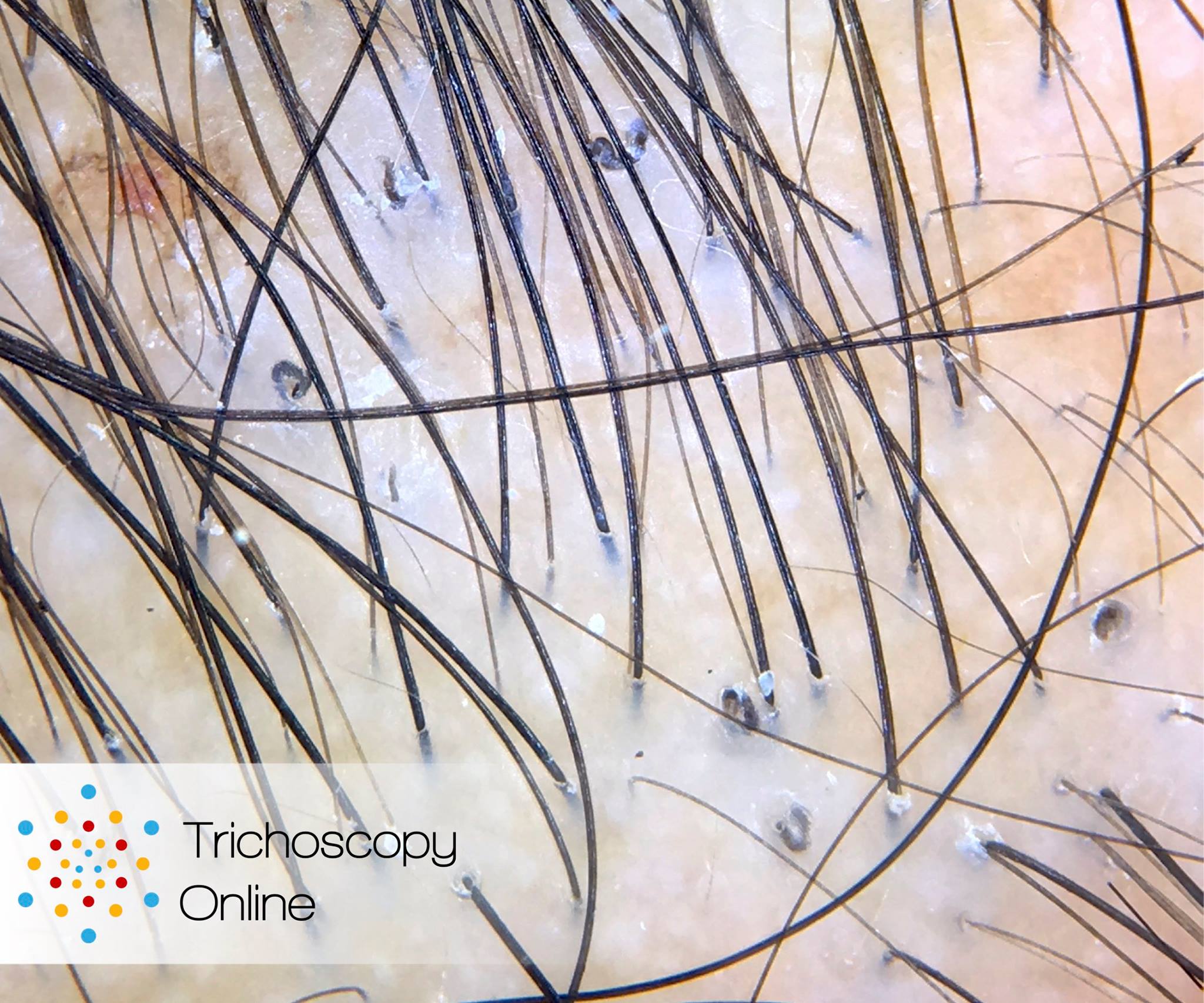 Trichoscopy Online - The answer to yesterday's quiz: C. Tinea Capitis ...