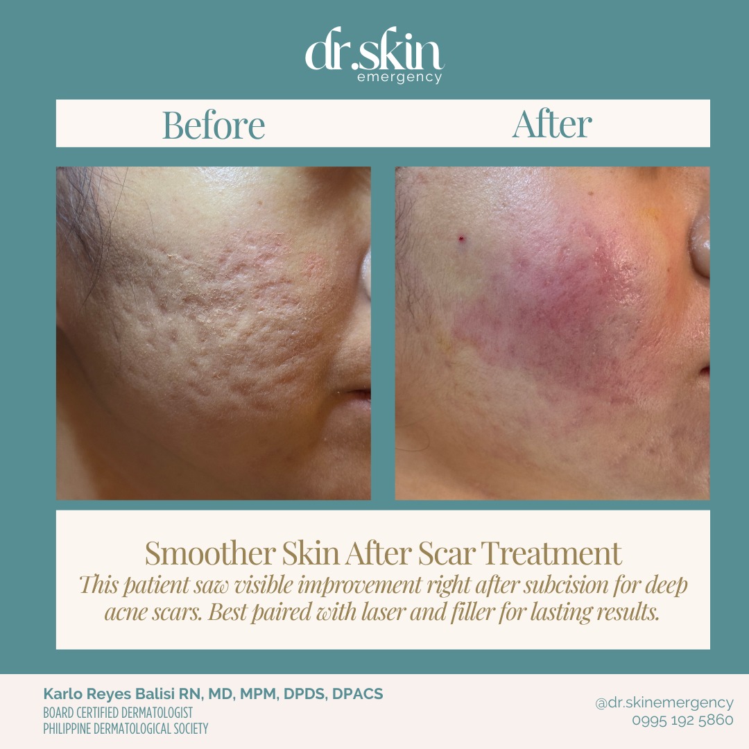 Dr. - This patient came in with deep rolling acne scars that had ...
