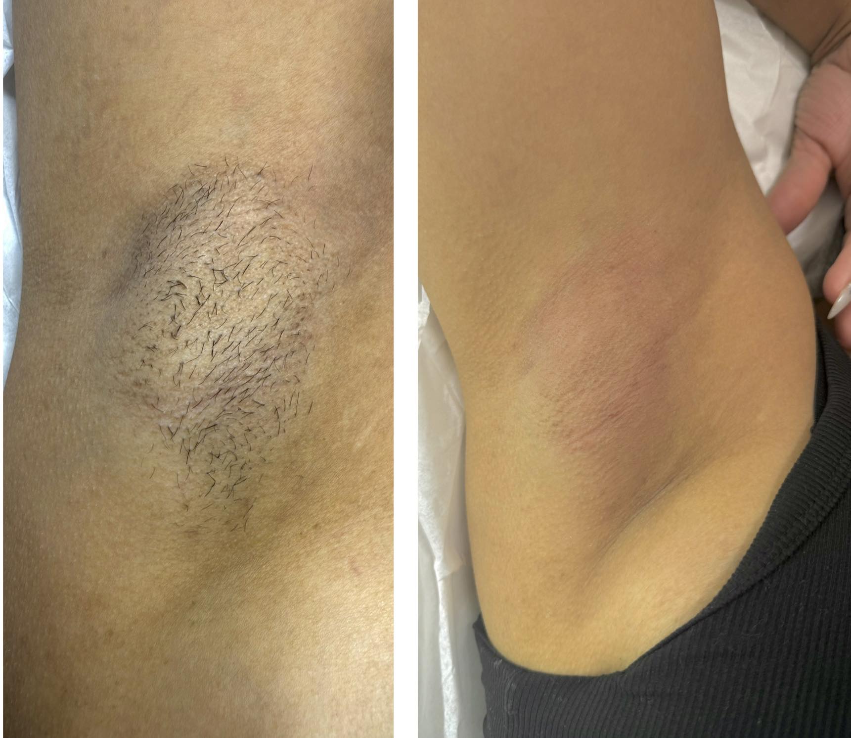 SKINS - UNDERARM WAXING Say goodbye to stubble, irritation, and daily ...
