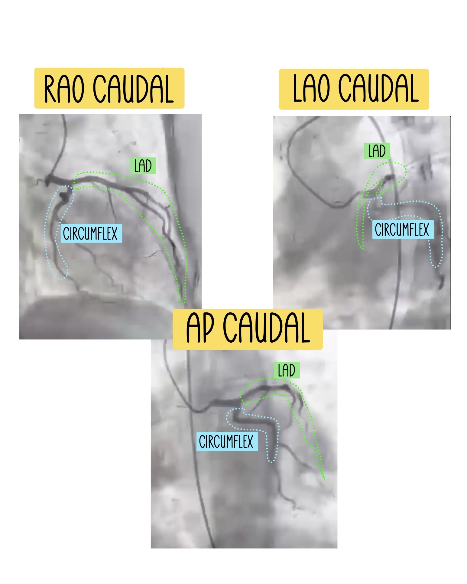 Don't - Recap on CAUDAL views, brings the CIRCUMFLEX to the center. RAO ...