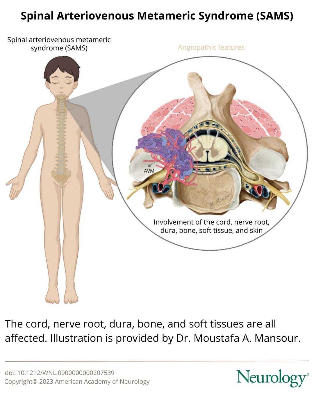 Spinal arteriovenous metameric... - Neurology Journal