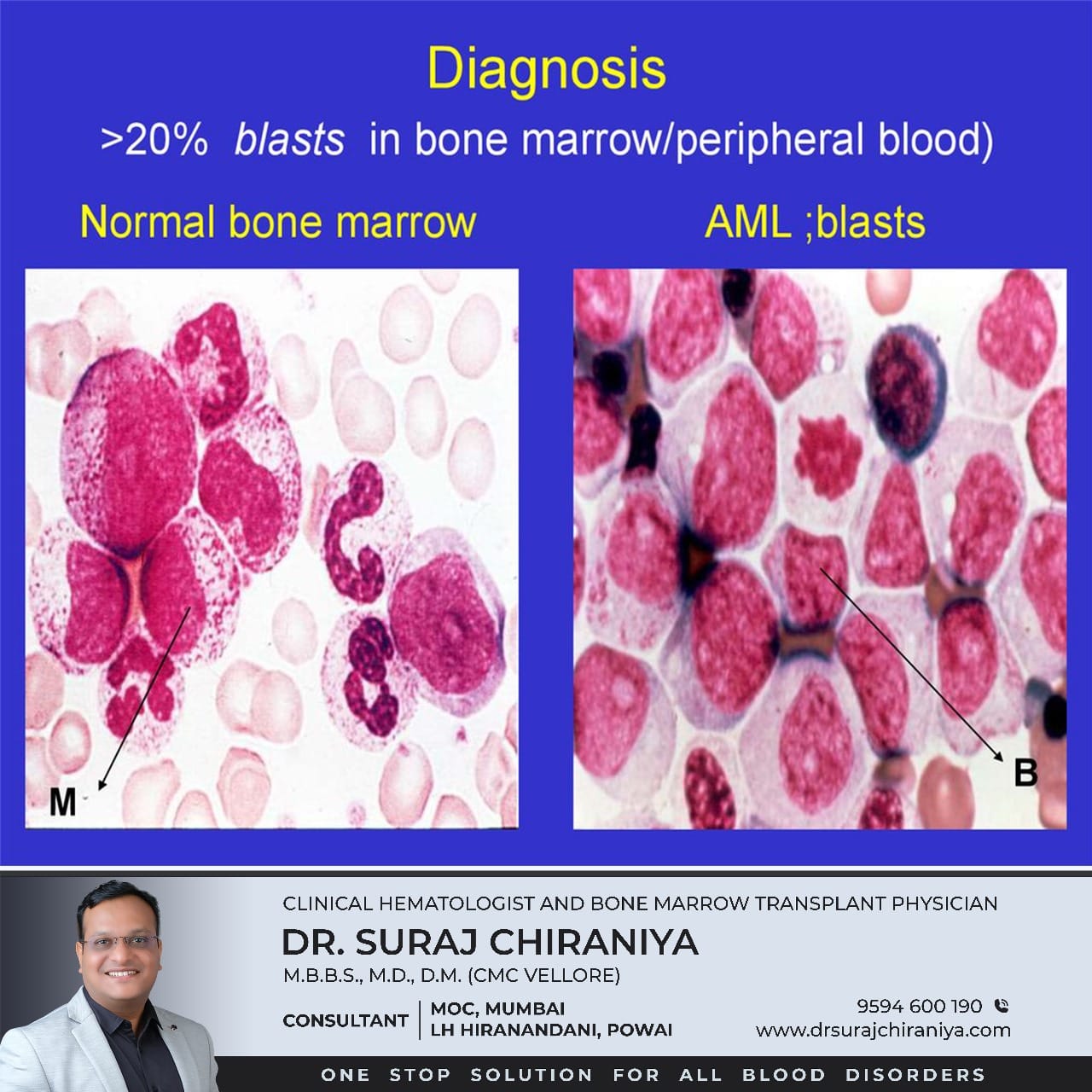 The diagnosis of Acute Myeloid... - Dr. Suraj Chiraniya