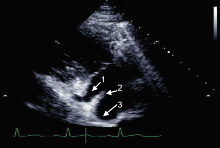 The structures depicted on the RV... - Cardiology in Images