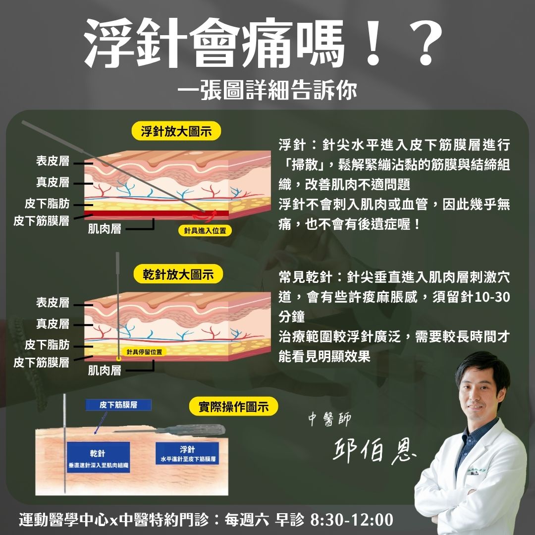 秀傳運動醫學中心 - 第一次聽到「浮針」，你是不是也在想…？ 會痛嗎？會流血嗎？？有副作用嗎？？？🧐... | Facebook