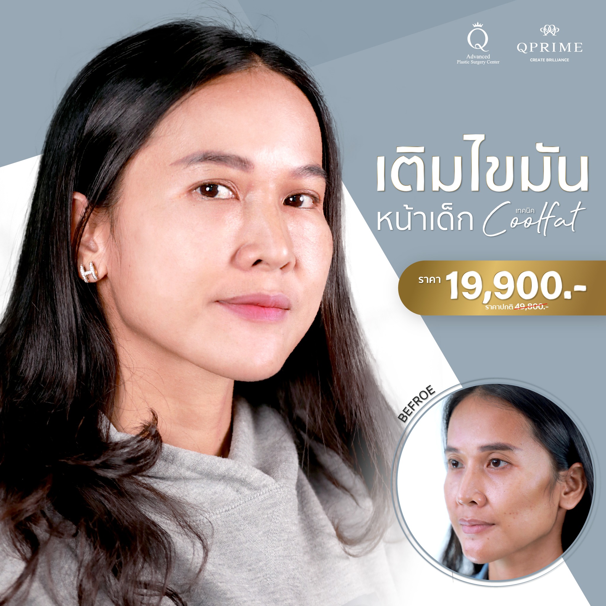นวัตกรรมการเติมไขม... - Qprime คิวไพร์ม ศัลยกรรมตกแต่งเฉพาะทาง | Facebook