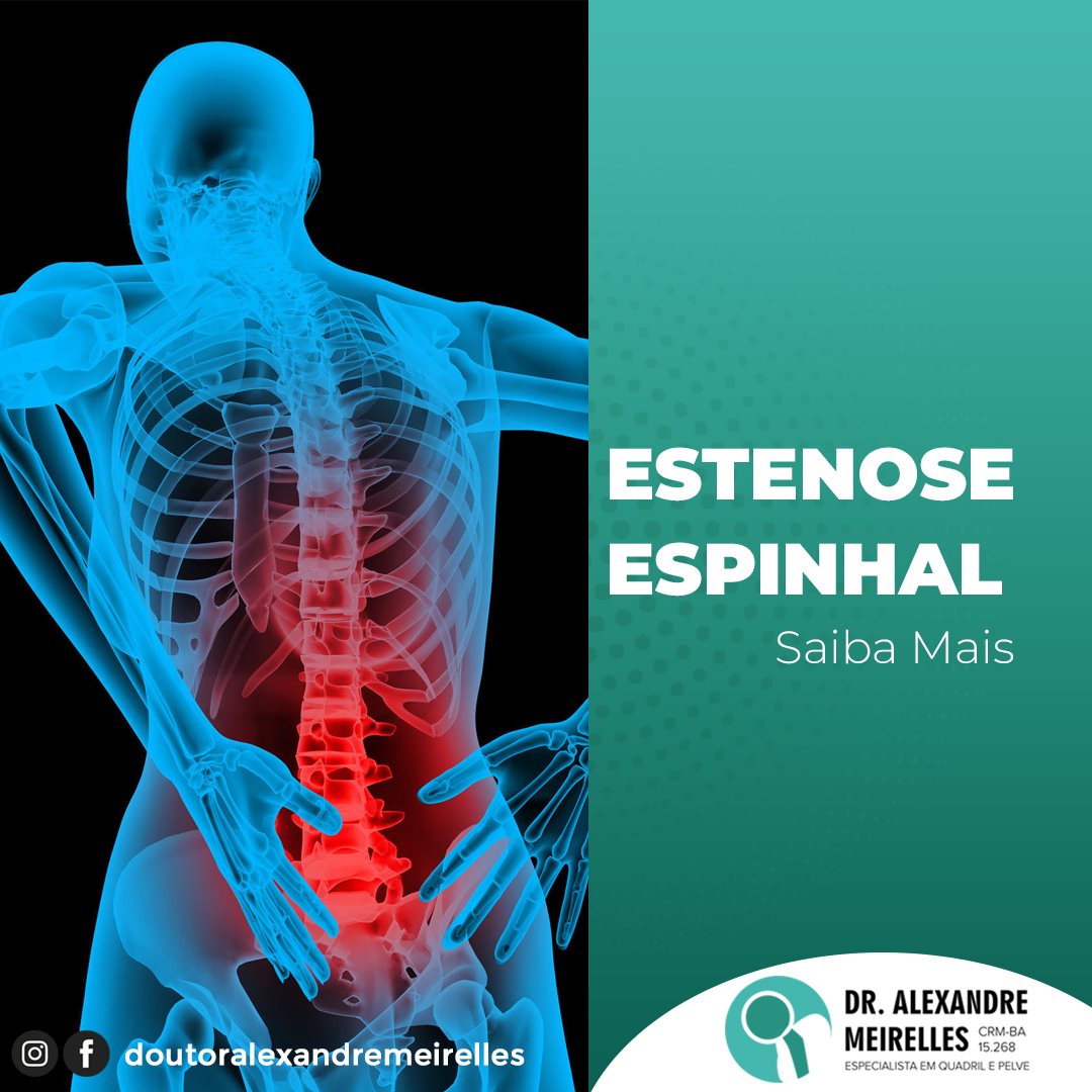 A estenose espinhal é uma doença... - Dr Alexandre Meirelles