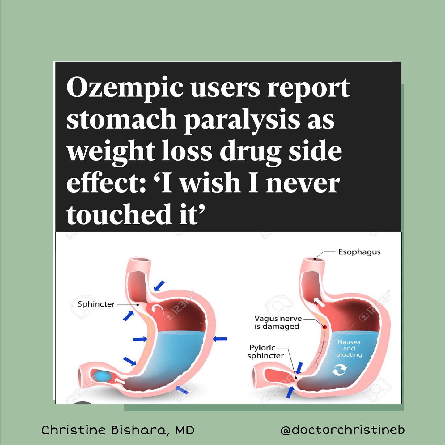Normally, the stomach empties within two to four hours of a meal. When taking GLP-1 medications, food sits in the stomach much longer than it should. The related side effects can range
