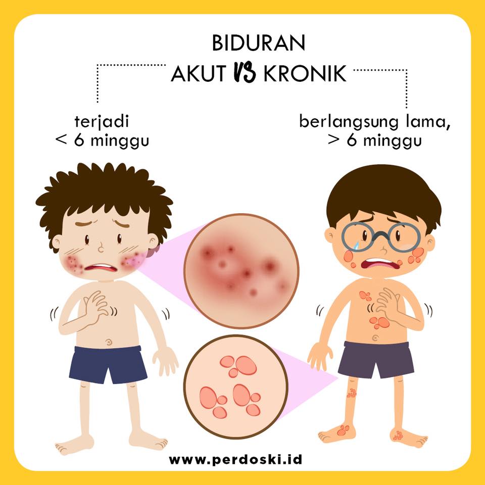 Perdoski - Kenali tentang biduran. Bila Anda mengalaminya,...