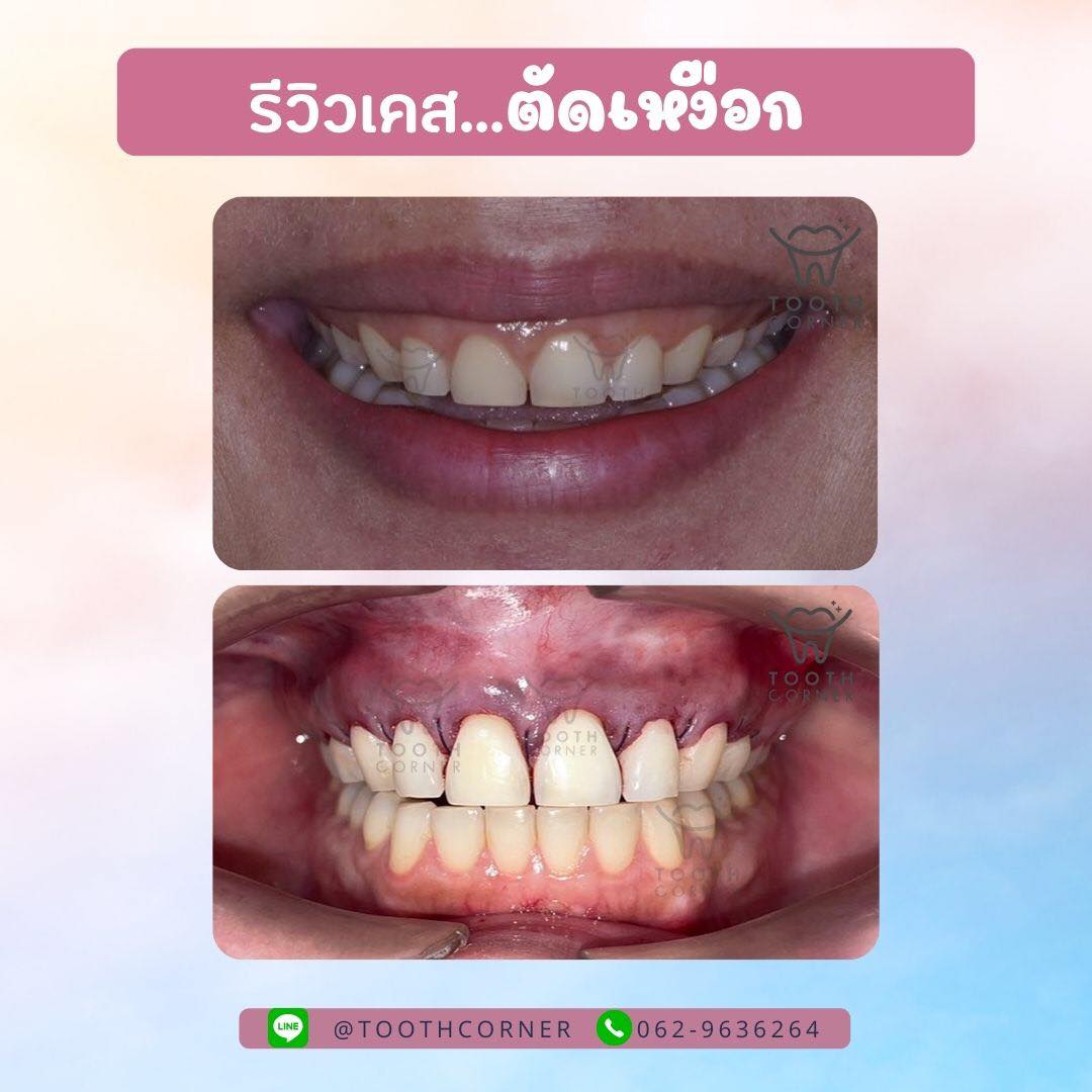 📣📢รีวิว…เคสตัด... - Tooth Corner Clinic - ทูธคอร์เนอะ สหคลินิก