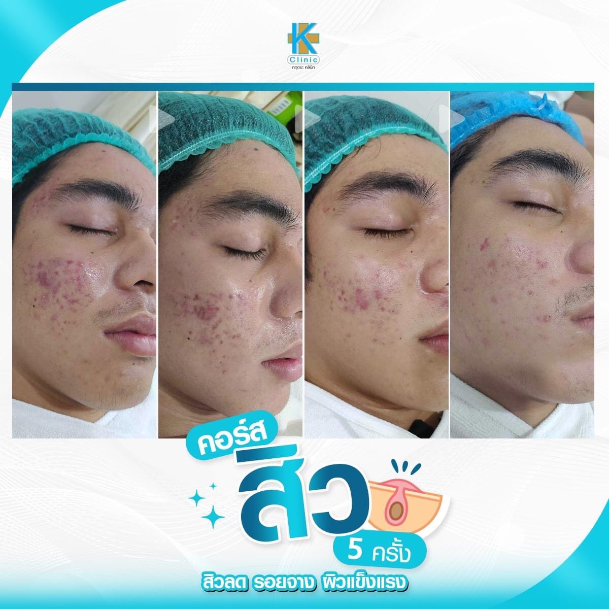 รักษาสิวที่หน้า - 4... - กฤตยะคลินิก สายไหม Krittaya Saimai | Facebook