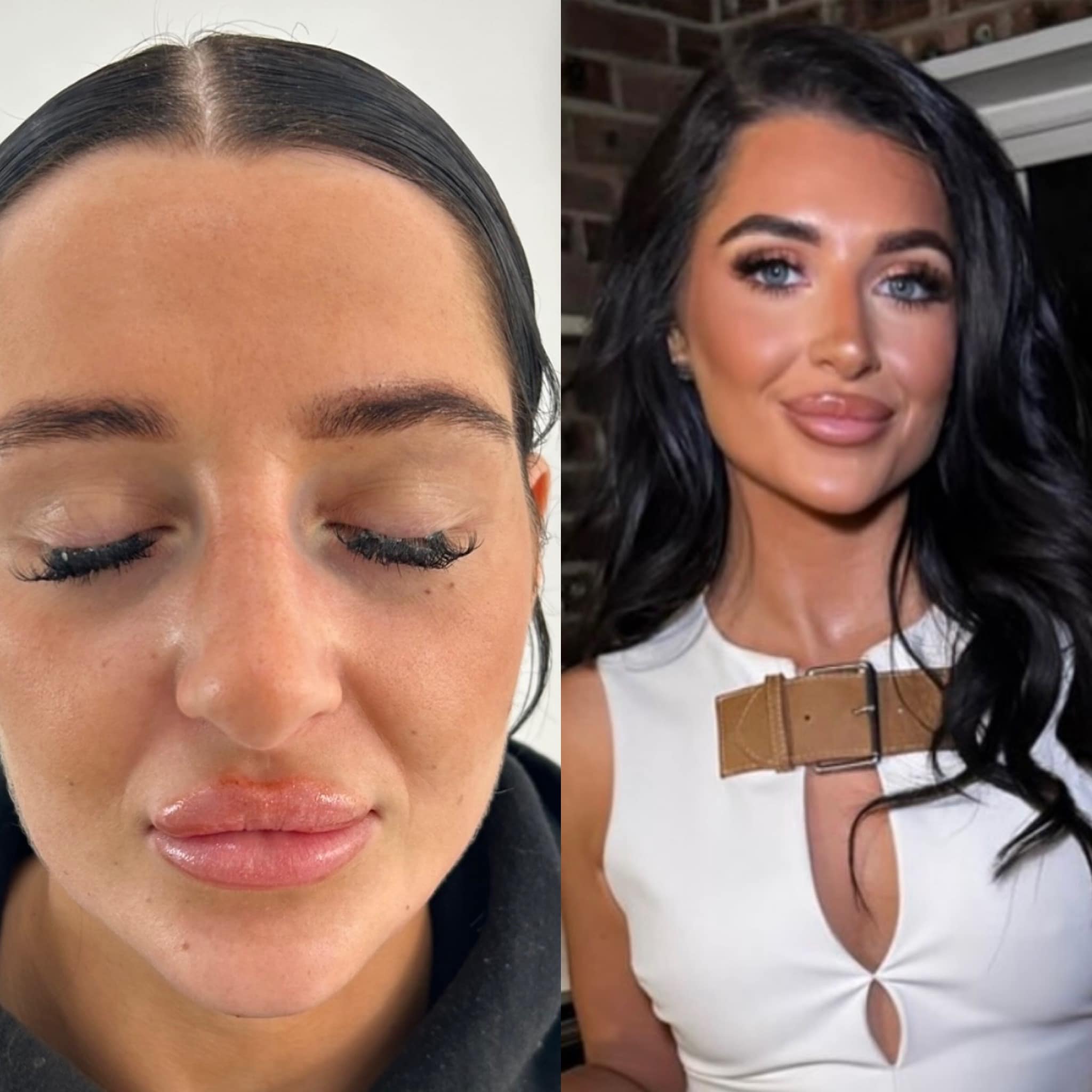 ❌🔥 Simply stunning 🔥❌ Lemon Bottle fat dissolver has some insane results 🍋 My lovely lady had under jaw lemon bottle treatment for a more defined look! First picture straight after treatment