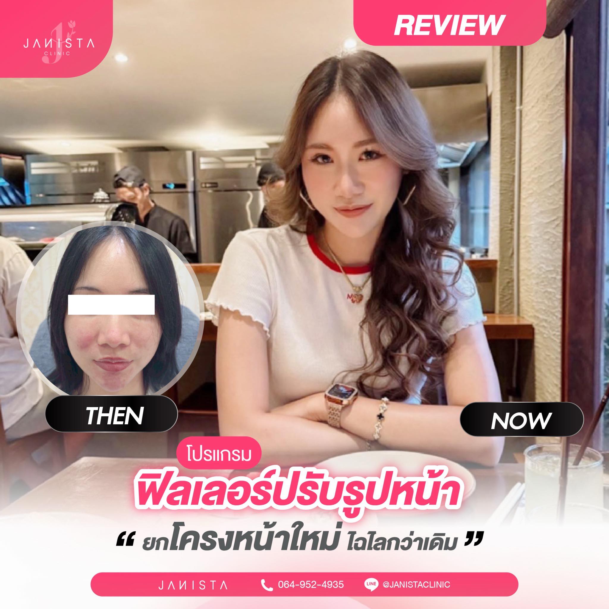 ปรับรูปหน้าแบบตัวแม่... - Janista Clinic - สาขาเชียงใหม่ | Facebook