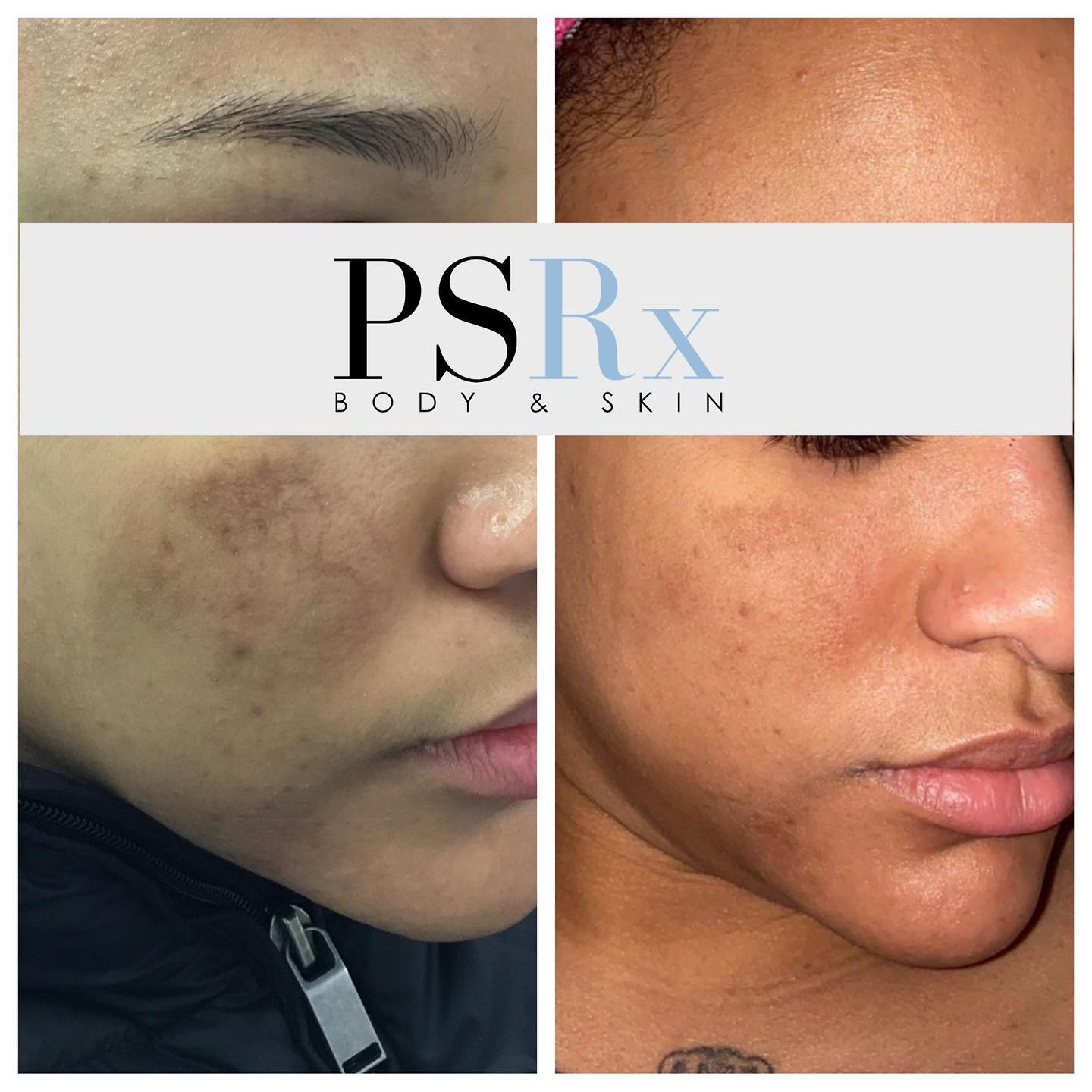 Microneedling with PRP... - Nurse Roni B Beauty & Body Junkie