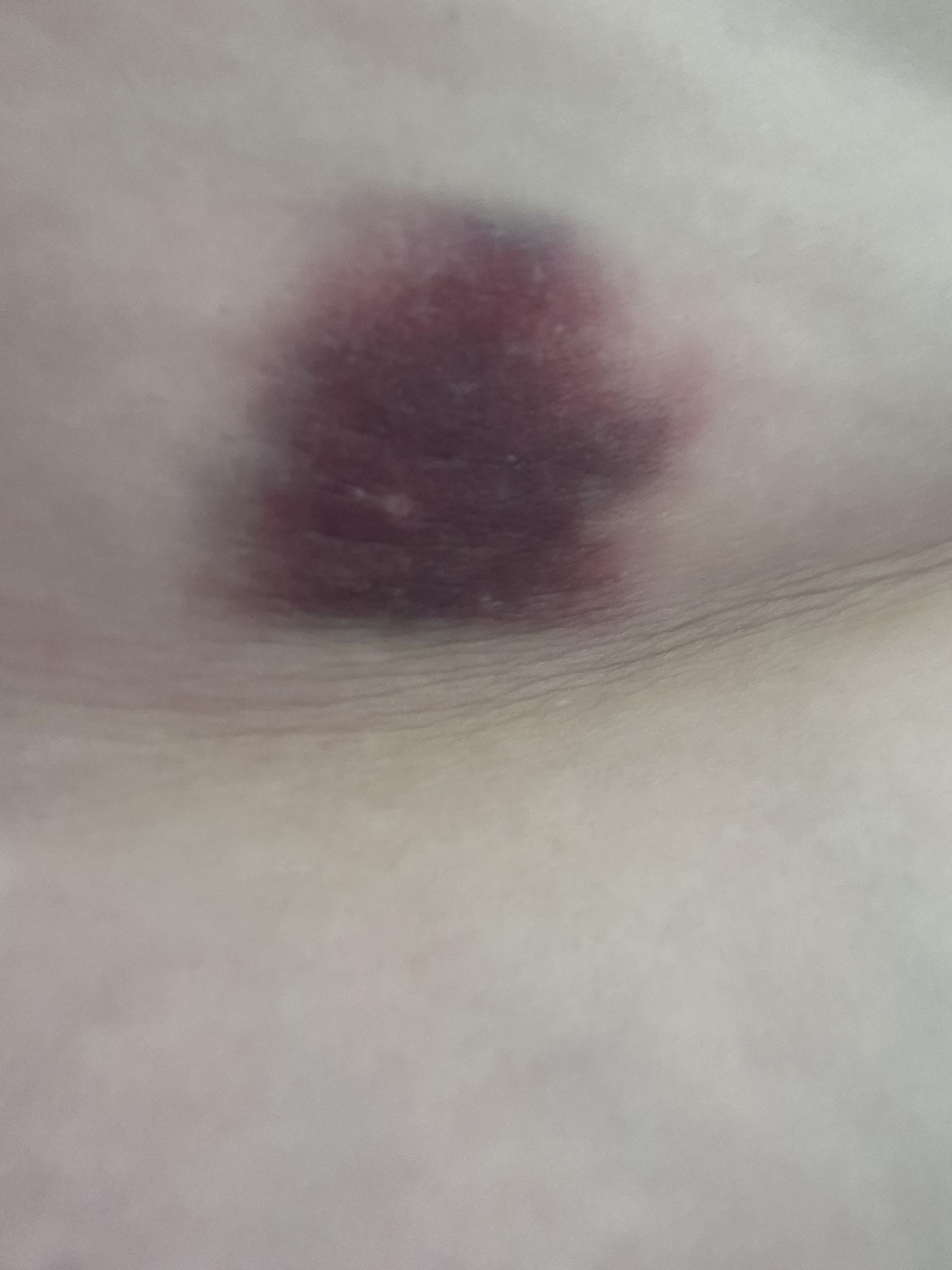 hit a vein while injecting b12 what happens when you during injection? Metabolic Regulation