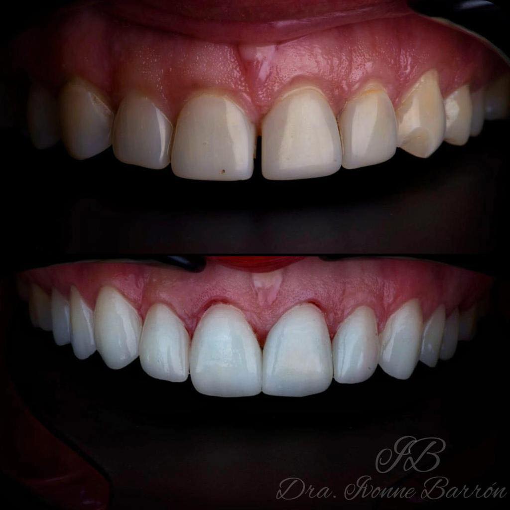 Dental Nakanami - Agulha Gengival PROCARE com bisel trifacetado, que ...