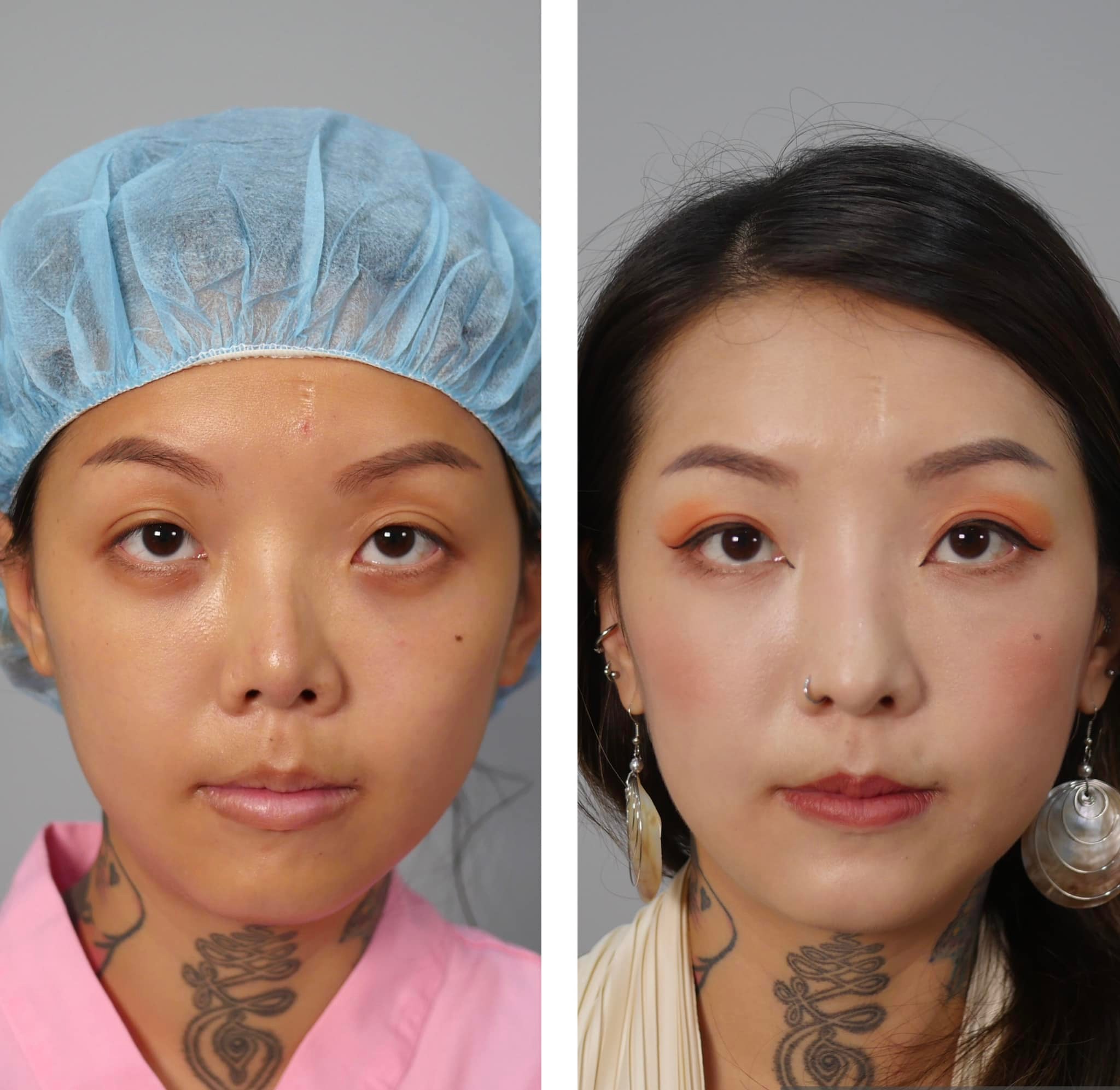 朱立箴醫師 結構式鼻整形 - 案例分享：重修鼻整形。 取出過去的L型一段式矽膠，同時做半自肋三段結構式。... | Facebook
