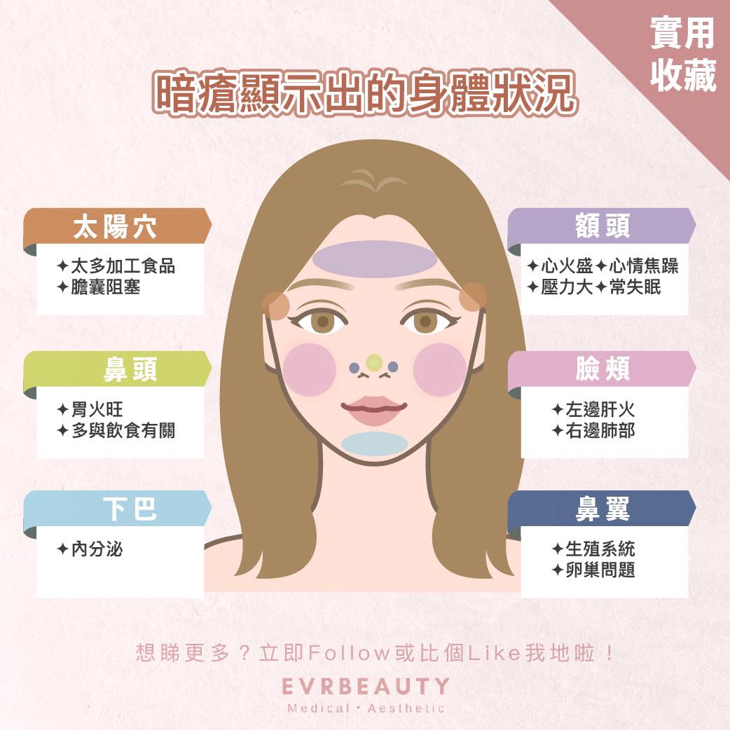 【暗瘡位置圖】🌞💦又到爆痘的夏季尾！中醫話，暗瘡也能顯示身... - EVRbeauty Medical Aesthetic