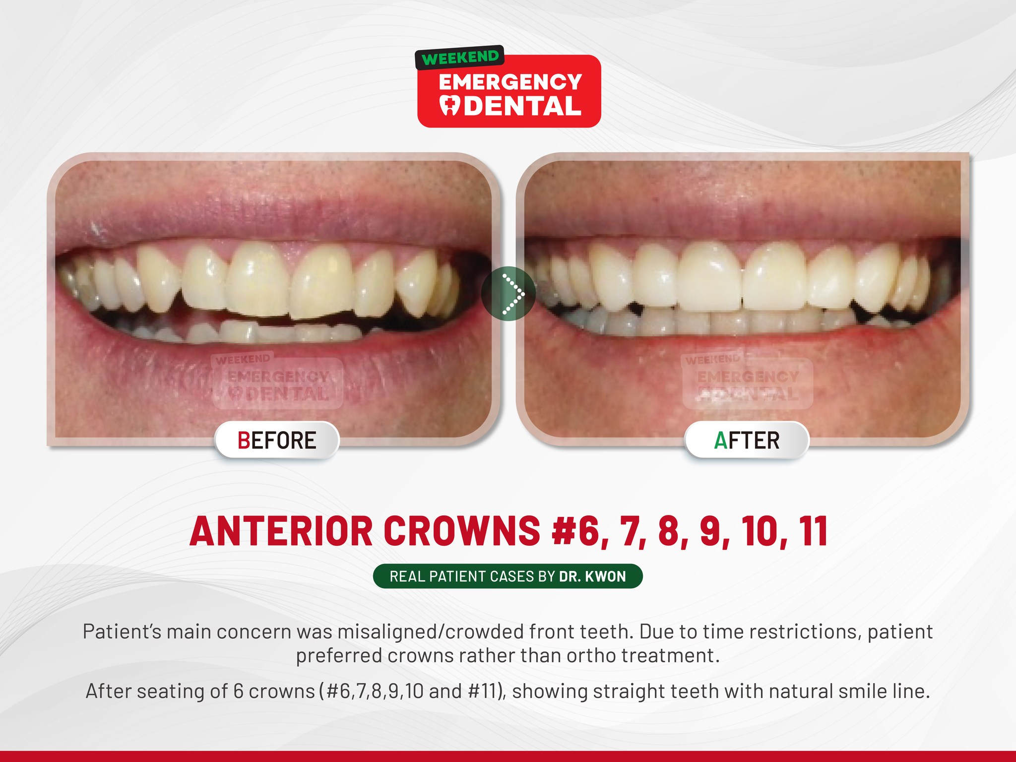 Weekend - Case Study Spotlight: Anterior crown restoration! Bringing ...