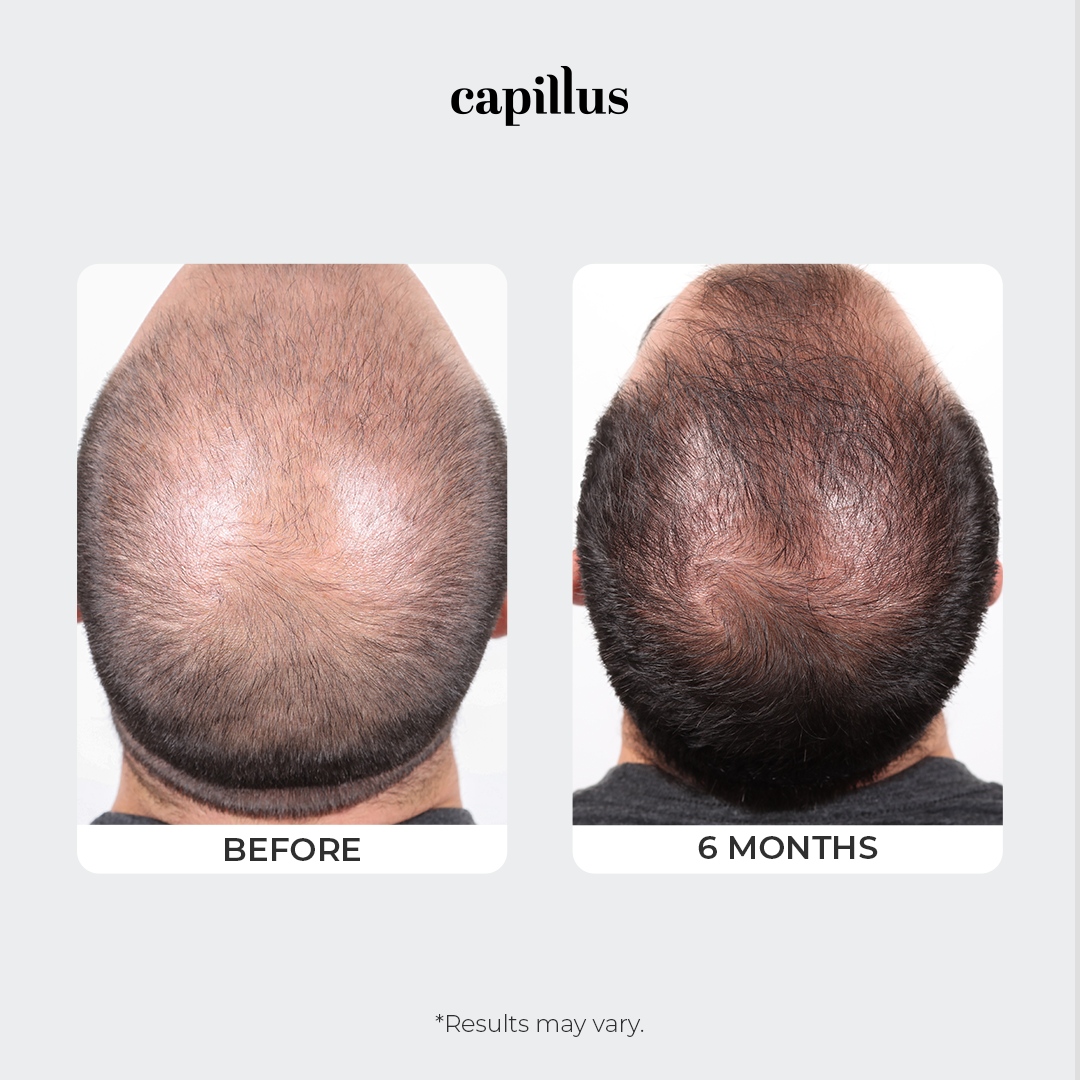 Capillus - Don't let hair loss define you 👊 Check out this impressive ...