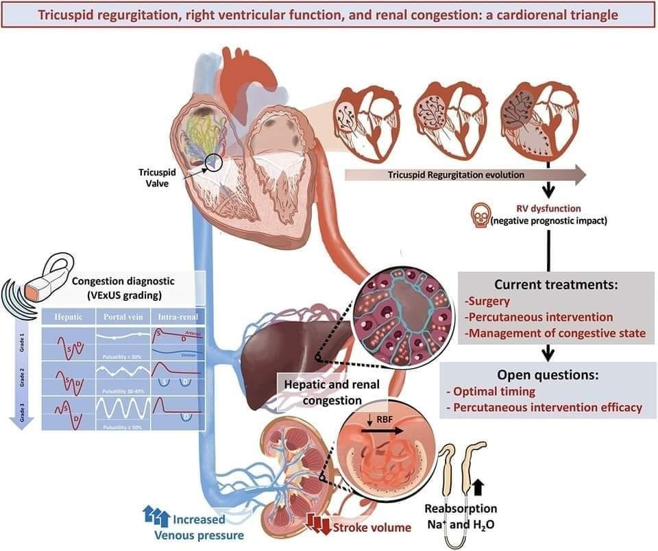 🔴 Tricuspid regurgitation, right... - Cardiology online