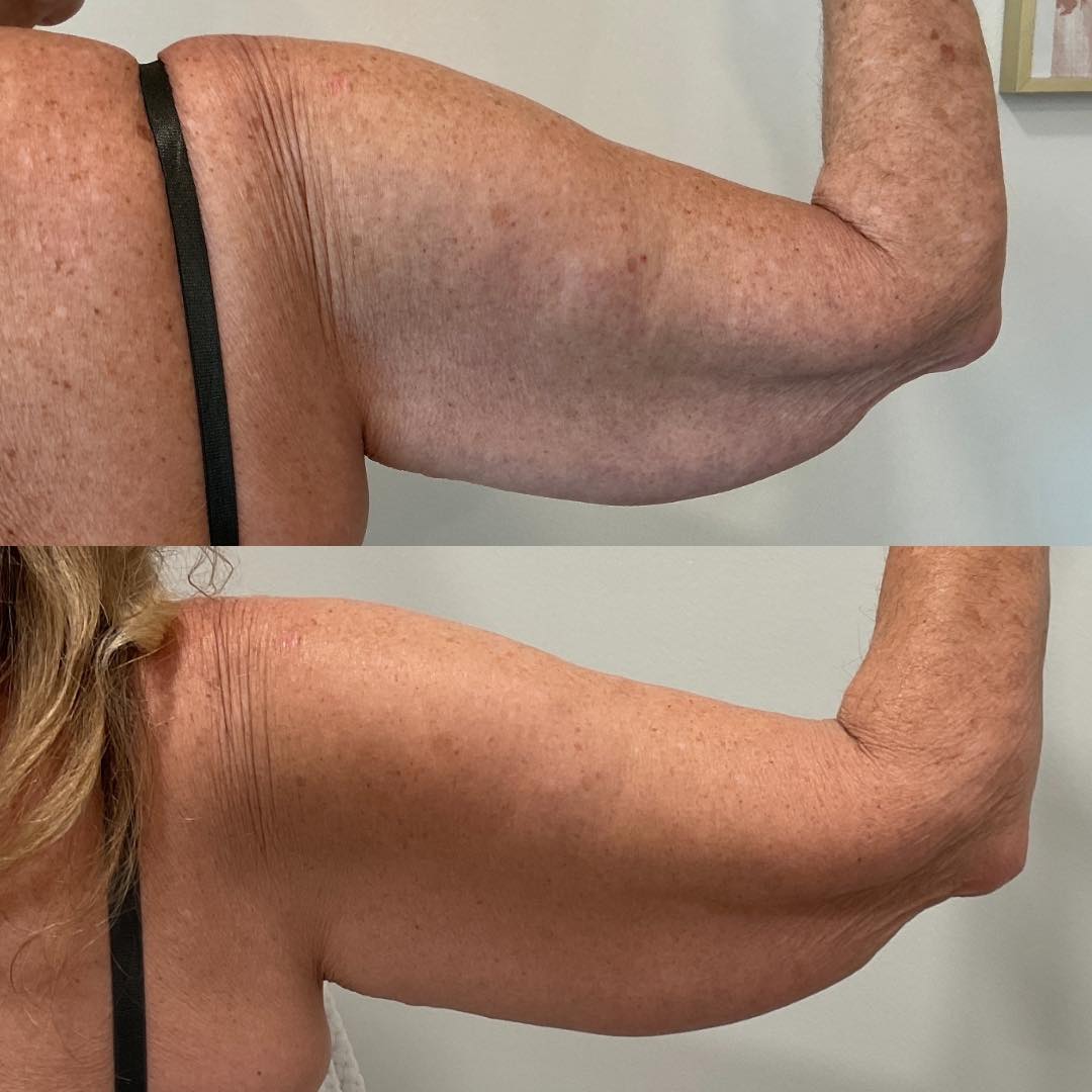Arms are one of the most common areas to show skin laxity