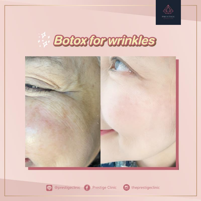 👍 BOTOX BUFFET... - Prestige clinic เพรสทีจ คลินิก เชียงใหม่ | Facebook