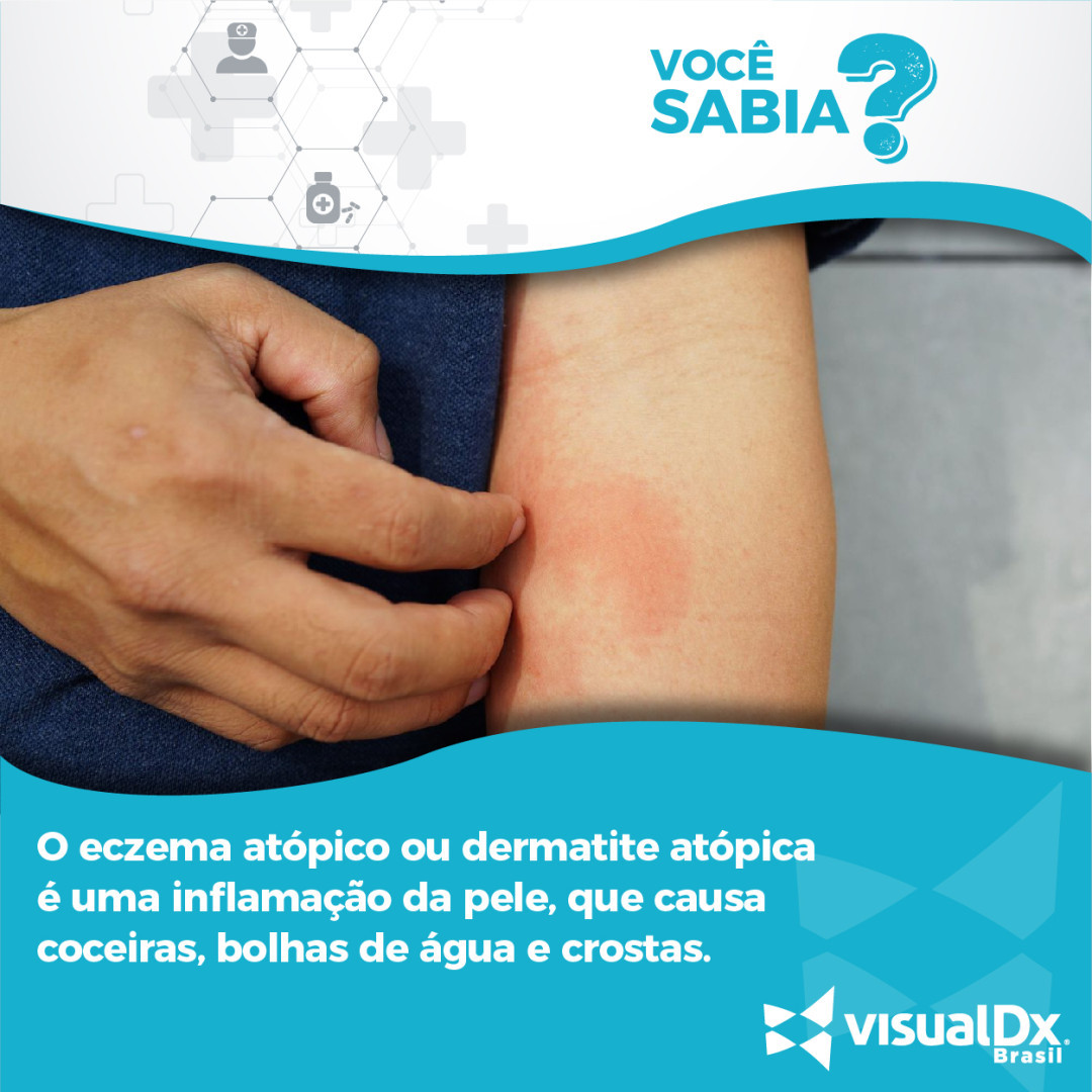 VisualDx Brasil - O tratamento do eczema é feito de acordo... | Facebook