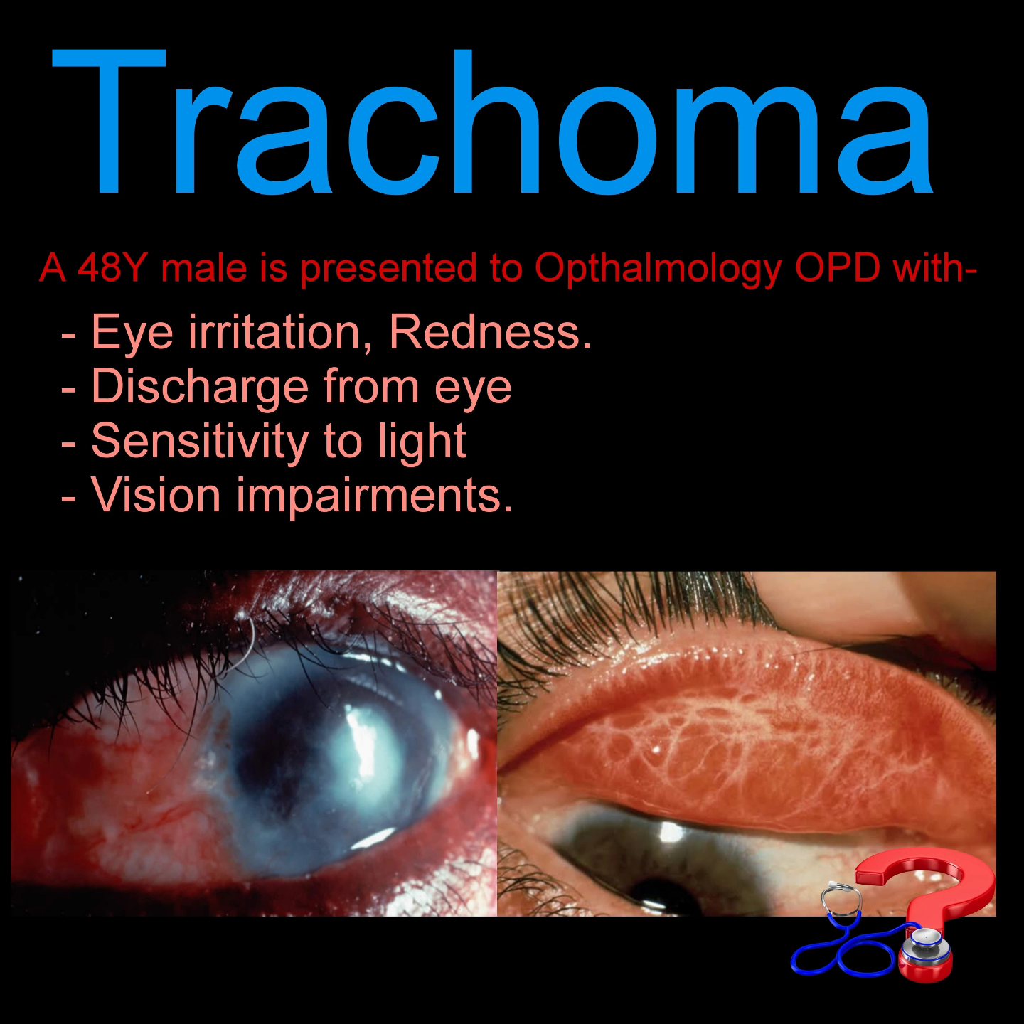 Diagnose - Trachoma is a contagious bacterial infection of the eyes ...