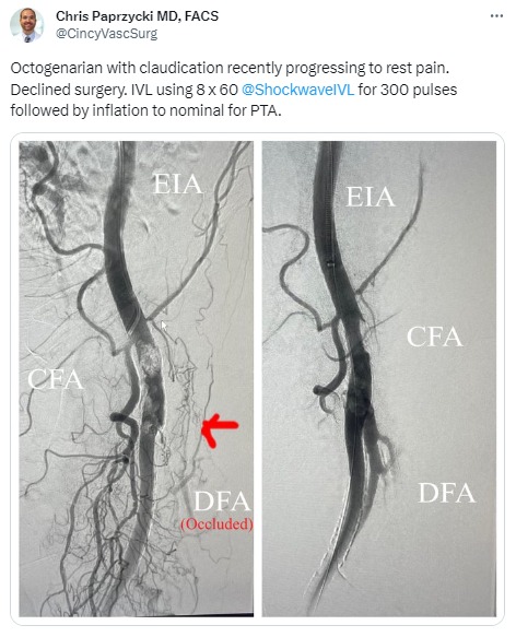 Shockwave - Cheers to Dr. Chris Paprzycki (@CincyVascSurg) for ...