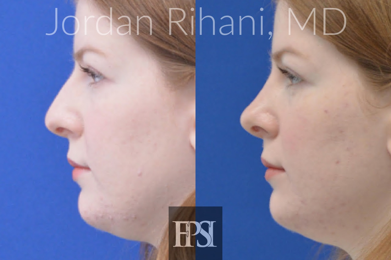 The central portion of... - Facial Plastic Surgery Institute