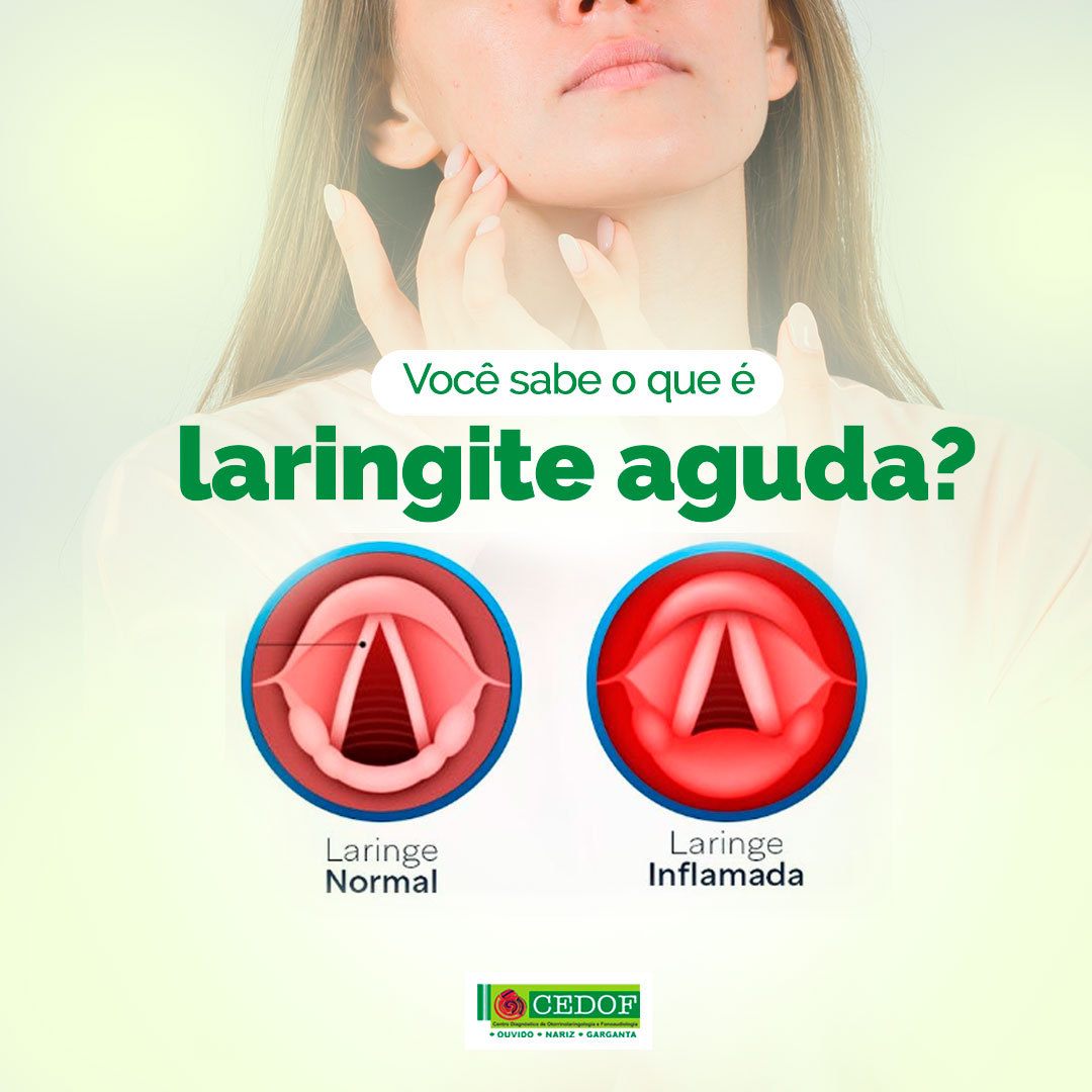 A laringite aguda é um... - CEDOF - Ouvido, Nariz e Garganta | Facebook
