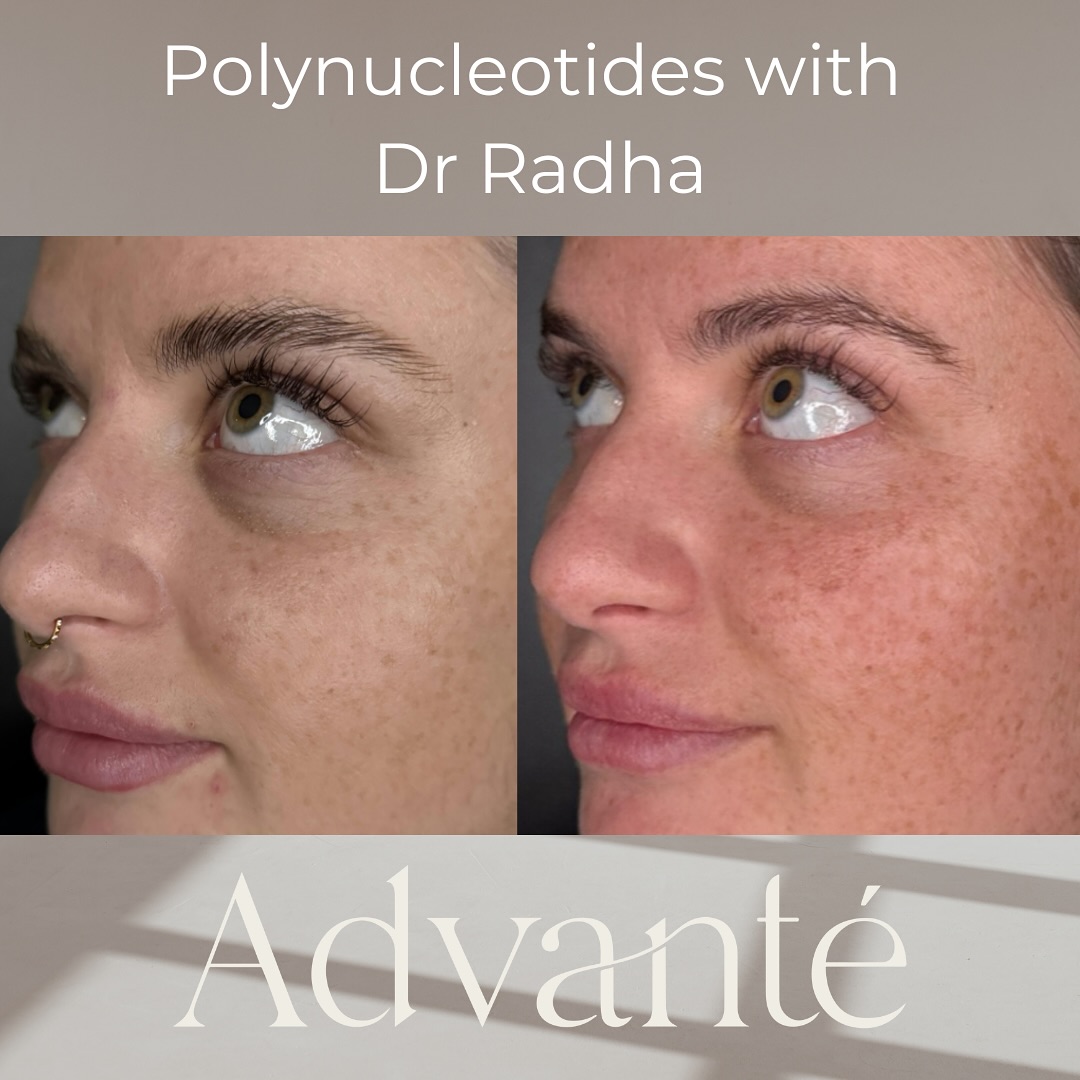 Advanté - Under-Eye Transformation with Polynucleotides Real patients ...