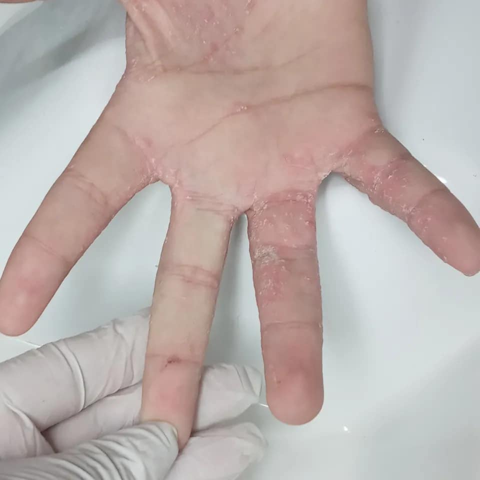 Keratodermia plantal causada... - Alicia Isendor podología