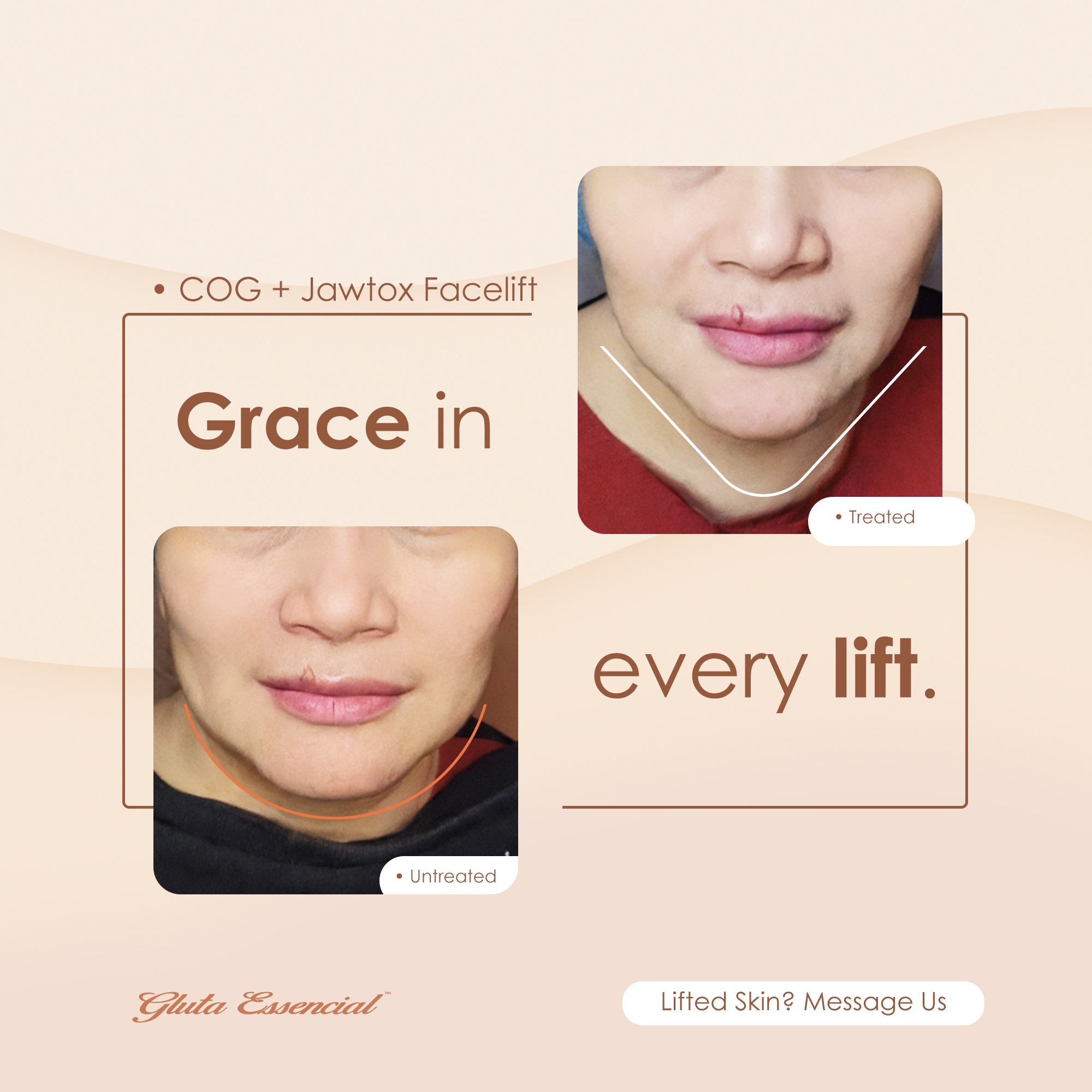 Gluta - Rediscover the beauty of a lifted, youthful you. Aging, stress ...