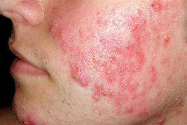 السلام عليكم ورحمة الله وبركاته هانكمل كلامنا عن حب الشباب Acne ...